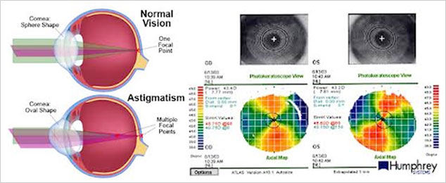 Astigmatism (ochi) - Wikipedia, Miopia cu astigmatism este