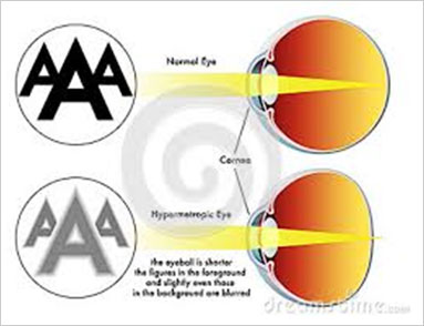 emberi látás myopia hyperopia)