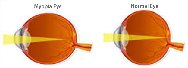 Myopia izom edzés, EMBERI TEST