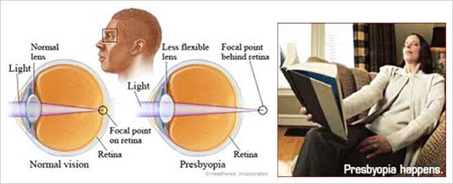 presbyopia wikipedia